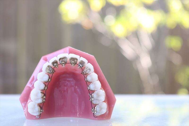 ホワイトニングは歯の矯正中でも施術できる？