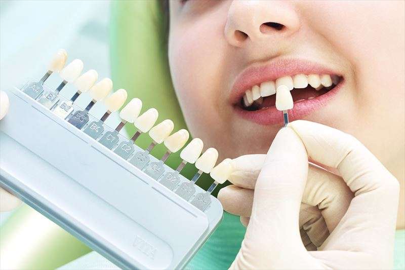 前歯だけのホワイトニングは可能？